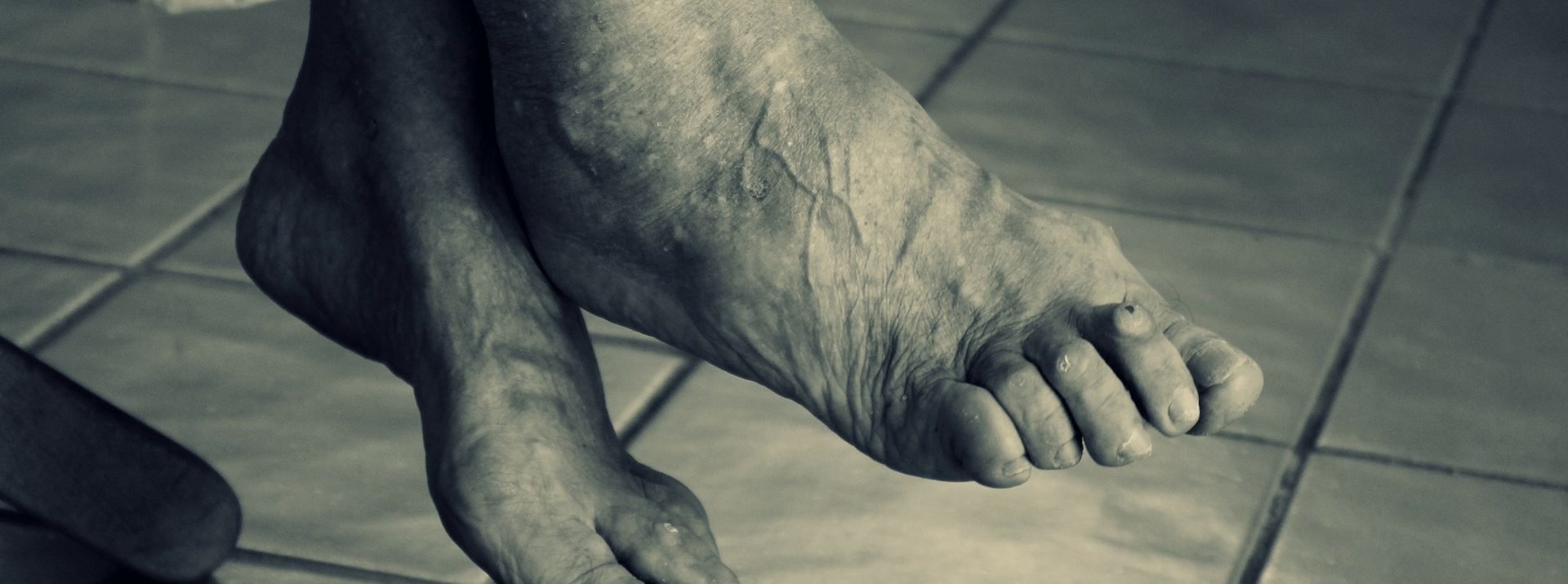 Podiatry Corns and Calluses