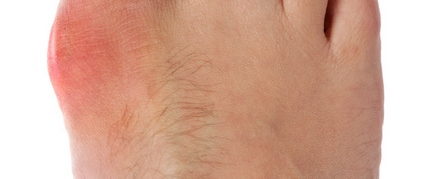 Podiatry Foot Specialist Bunion Care