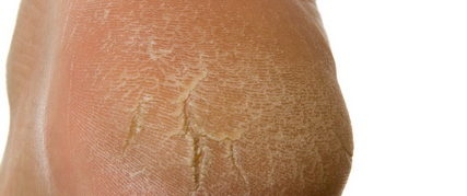 Podiatry help for Cracked Heels