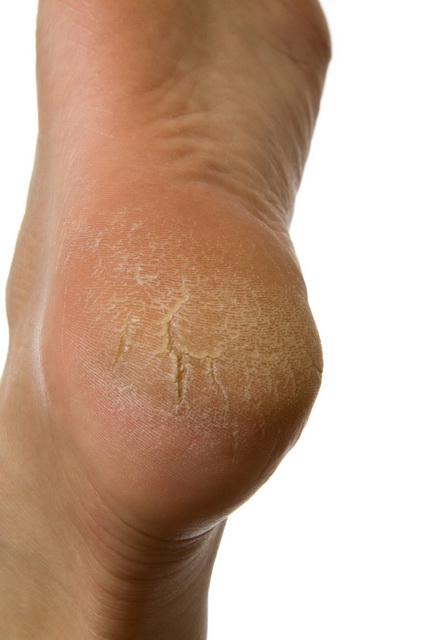Podiatry help for Cracked Heels