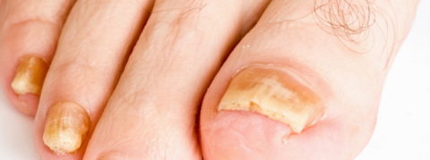 Podiatry help for Fungal Toenails in Melbourne Australia