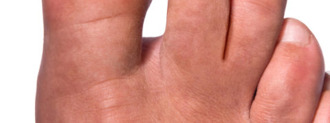 Podiatry treatment for ingrown toenails