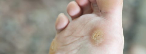 Podiatry treatments for plantar warts