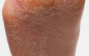 Podiatry Tinea Pedis Foot Fungal Infection Treatments