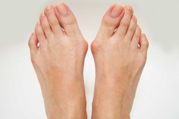 Bunions