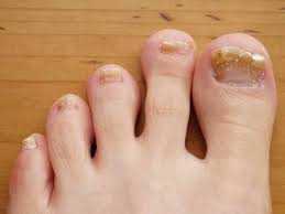 Fungal Toenails