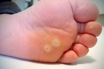 Plantar Warts